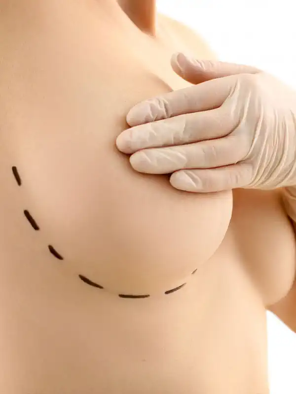 Breast Lifting with Implants